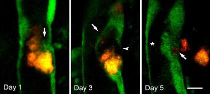 Three-part image of blood vessel showing a blockage that is encapsulated and then expelled through the outer blood vessel wall