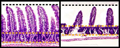 Microscopic images with healthy finger-like structures in top panel and blunted, damaged ones in bottom panel Microscopic images with healthy finger-like structures in top panel and blunted, damaged ones in bottom panel