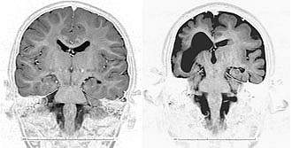 Images of 2 brain scans; the one on the right is smaller with deeper folds and a large central hole. Images of 2 brain scans; the one on the right is smaller with deeper folds and a large central hole.