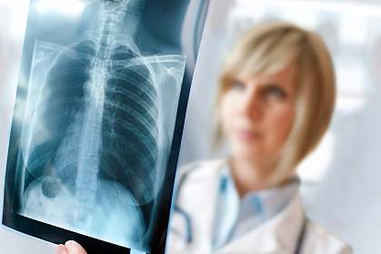Photo of a doctor viewing a chest x-ray Photo of a doctor viewing a chest x-ray