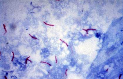 Microscopic image of rod-shaped TB bacteria Microscopic image of rod-shaped TB bacteria.