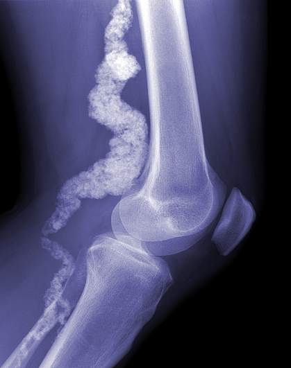 X-ray photo of a knee X-ray photo of a knee
