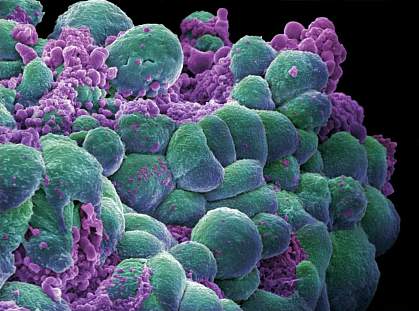 Electron microscope image showing a cluster of misshapen cells Electron microscope image showing a cluster of misshapen cells