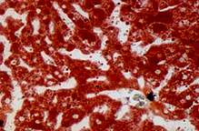 Two microscope images of liver, the left one heavily marbled with red Two microscope images of liver, the left one heavily marbled with red