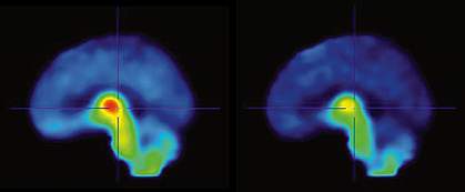 PET scan images of 2 human brains, with the top brain showing a patch of red at center PET scan images of 2 human brains, with the top brain showing a patch of red at center