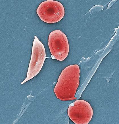lectron micrograph of a sickle shaped cell on the left and several rounded cells on the right. lectron micrograph of a sickle shaped cell on the left and several rounded cells on the right.