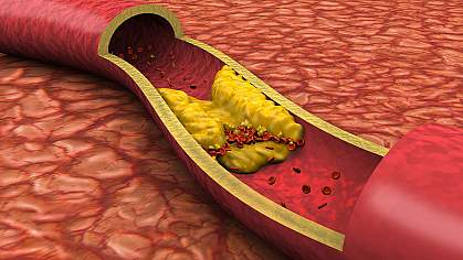 Illustration shows an open artery with a yellow fatty deposit. Illustration shows an open artery with a yellow fatty deposit.