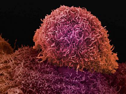 Scanning electron micrograph of a prostate cancer cell Scanning electron micrograph of a prostate cancer cell