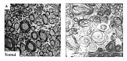 Photos showing cross sections of normal brain on left and abnormal brain on right. Photos showing cross sections of normal brain on left and abnormal brain on right.