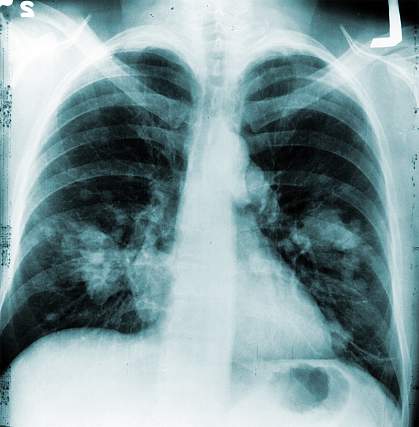 X-ray of chest X-ray of chest