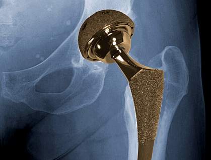Hip showing metal-on-metal implant Hip showing metal-on-metal implant