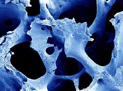 Brittle, broken bone structure Brittle, broken bone structure.