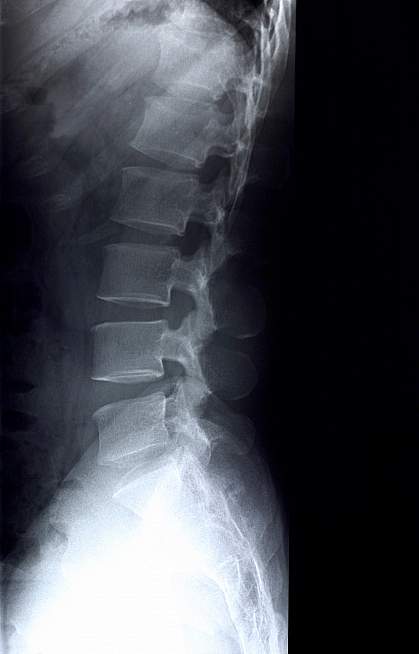 X-ray of lumbar spine X-ray of lumbar spine.