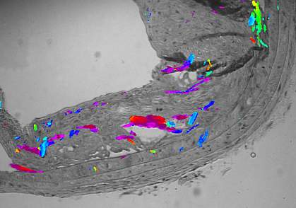 Microscope image showing scattered colored area within a blood vessel Microscope image showing scattered colored area within a blood vessel.
