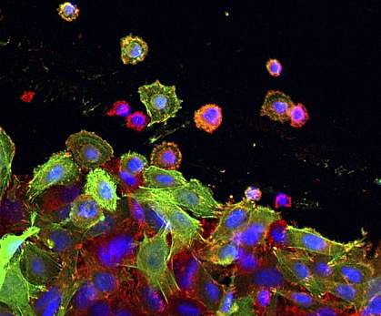 Colon cancer cells Colon cancer cells.