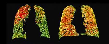 Lungs with green, yellow and red areas Lungs with green, yellow and red areas.