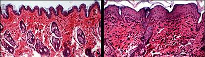 Two microscopic images of mouse skin, one normal and one inflamed. Two microscopic images of mouse skin, one normal and one inflamed.