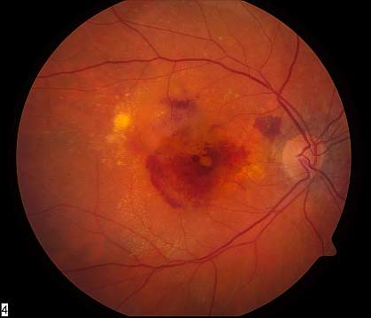 Eye affected by Age-related Macular Degeneration Eye affected by Age-related Macular Degeneration