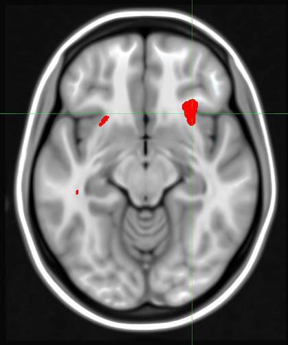 A brain scan showing red areas in the front half of the brain A brain scan showing red areas in the front half of the brain