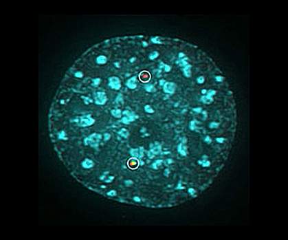 Chromosome translocation Chromosome translocation