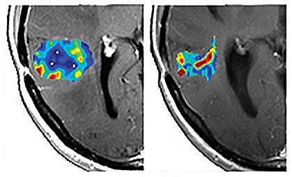Left brain MRI shows larger area of color than the right. Left brain MRI shows larger area of color than the right.
