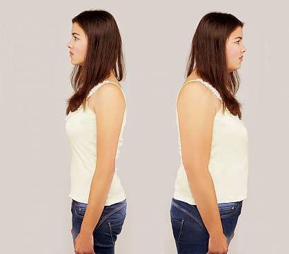 Twins, one obese and one lean Twins, one obese and one lean.