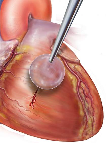 Illustration of patch being applied to heart tissue Illustration of patch being applied to heart tissue.