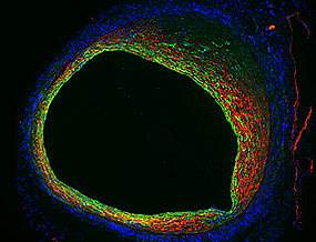 A narrowing blood vessel A narrowing blood vessel.