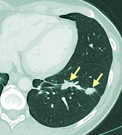 Shrunken tumor Shrunken tumor.