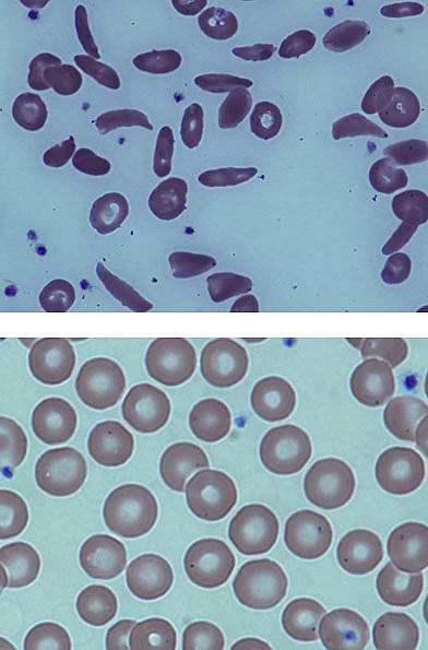 Sickle-shaped blood cells in top panel and round cells in bottom panel Sickle-shaped blood cells in top panel and round cells in bottom panel.