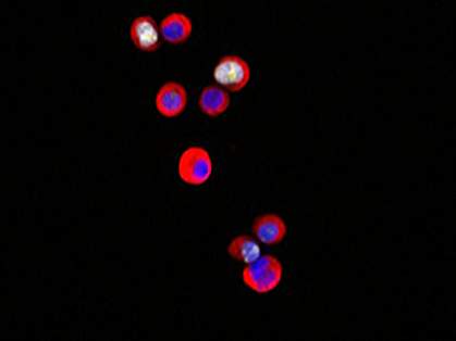 Tumor cells color red and blue Tumor cells color red and blue.