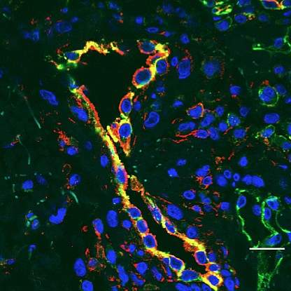 Inflamed blood vessels Inflamed blood vessels.
