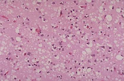 Brain tissue of a CJD patient Brain tissue of a CJD patient