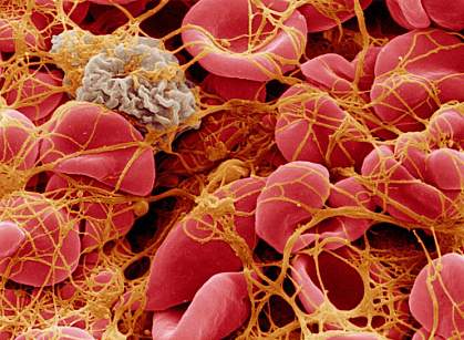 Cells in a blood clot Cells in a blood clot.