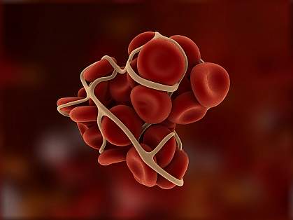 Illustration of a blood clot Illustration of a blood clot.