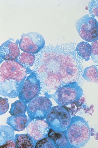 HIV-infected cells HIV-infected cells.