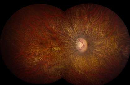 retinal photo