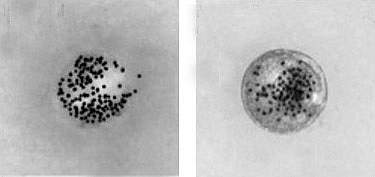 GPC1biomarker Transmission electron micrograph of an exosome