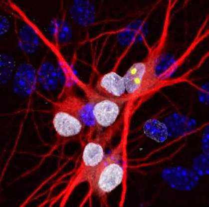 Neurons from an ALS patient Neurons from an ALS patient
