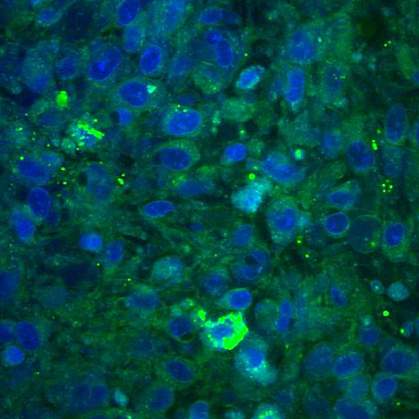 Normal brain with sparse cells with bundles of nerve fibers. Brain tumor tissue with cells in a disordered pattern.