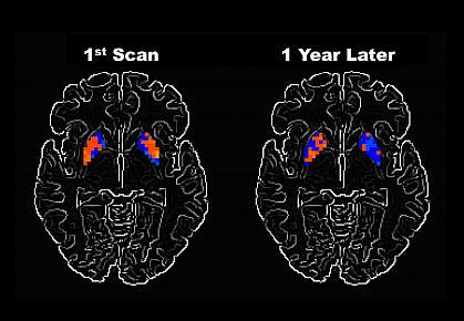 Brain scans taken a year apart show different levels of activity in certain areas.