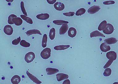 Sickled cells Sickled cells
