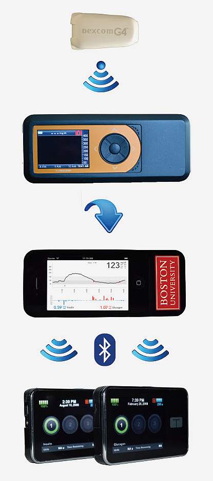 Bionic Illustration of the bionic pancreas system