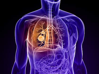 Diagram of a torso with a tumor in the lung Diagram of a torso with a tumor in the lung