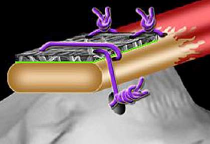 Illustration of scaffold on tendon. Illustration of scaffold on tendon.