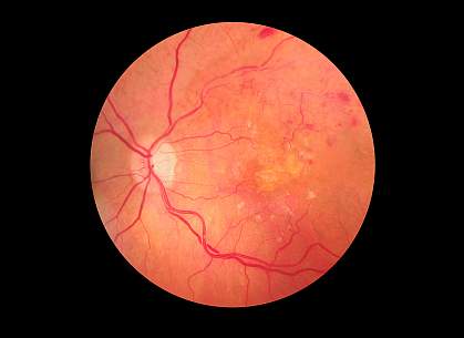 Medical photo of retinopathy Medical photo of retinopathy