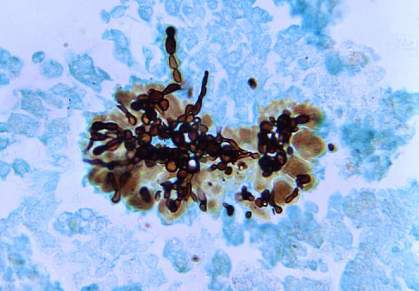 Photomicrograph of liver tissue specimen with dark chains of fungi. Photomicrograph of liver tissue specimen with dark chains of fungi.