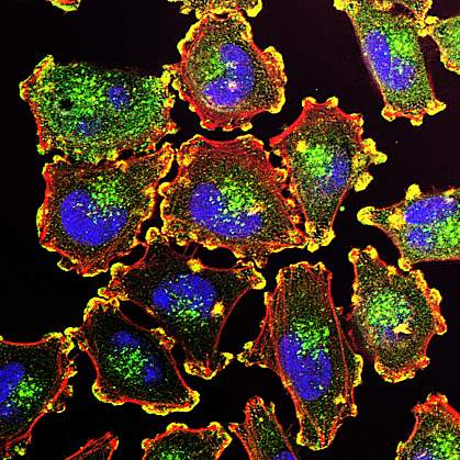 Metastatic melanoma cells Metastatic melanoma cells