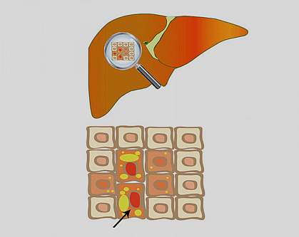 Illustration of a liver with old cells filled with fat Illustration of a liver with old cells filled with fat