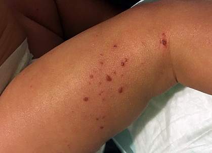 Child with eczema Child with eczema